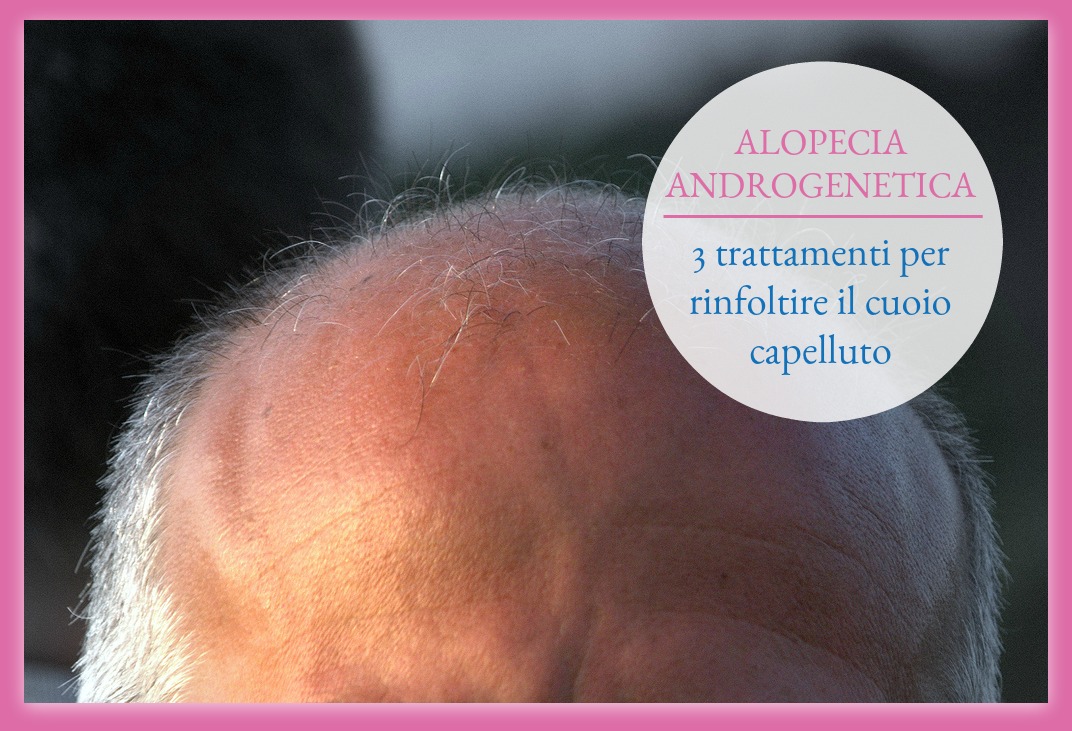 alopecia androgenetica